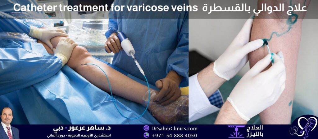 علاج الدوالي بالقسطرة والليزر أو الموجات الصوتية، وتطبيق علاج القسطرة على دوالي الساق