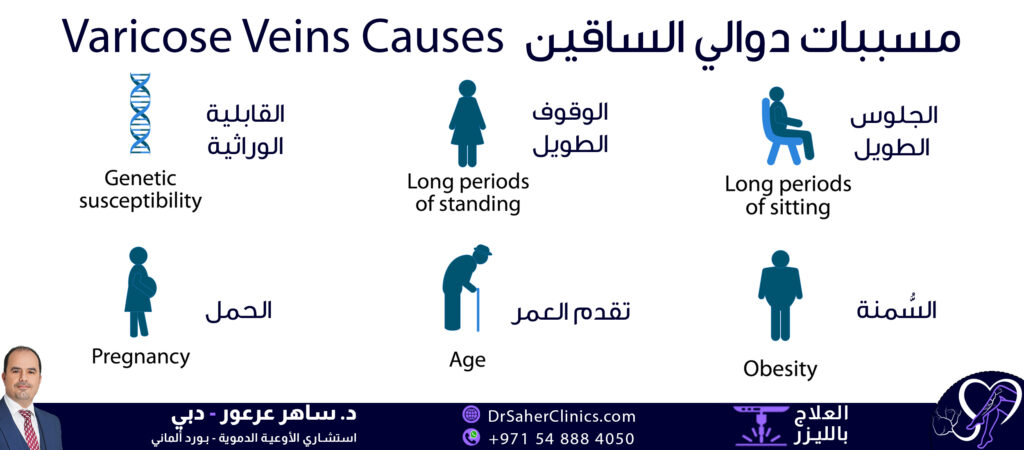 أسباب دوالي الساقين، وهي أمور تزيد من إحتمال الإصابة بدوالي الساقين، بعضها يمكن تفاديها