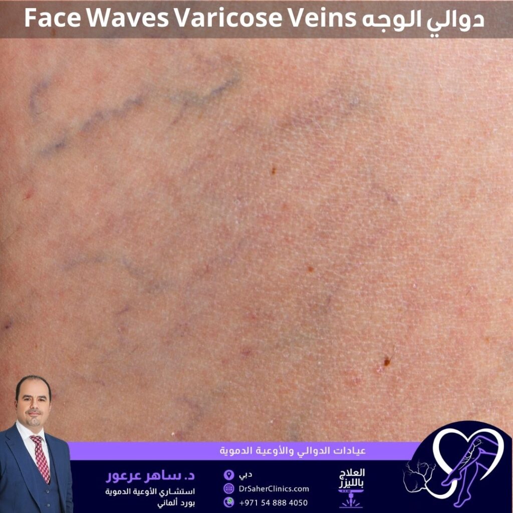 دوالي الوجه