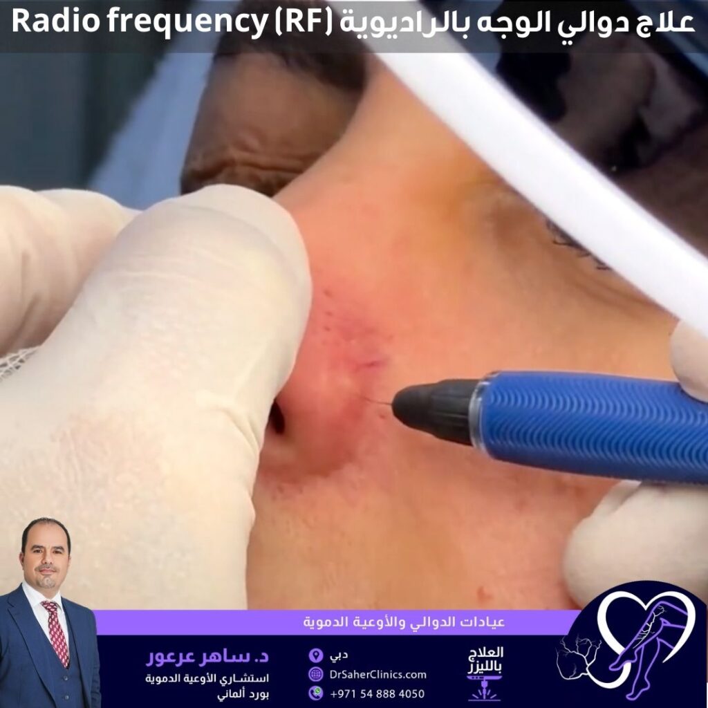 علاج دوالي الوجه بالراديوية Radio frequency (RF)