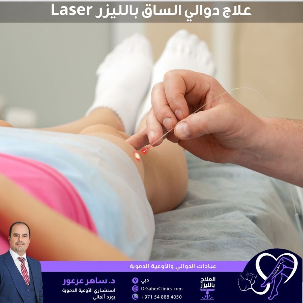 علاج الدوالي بالليزر