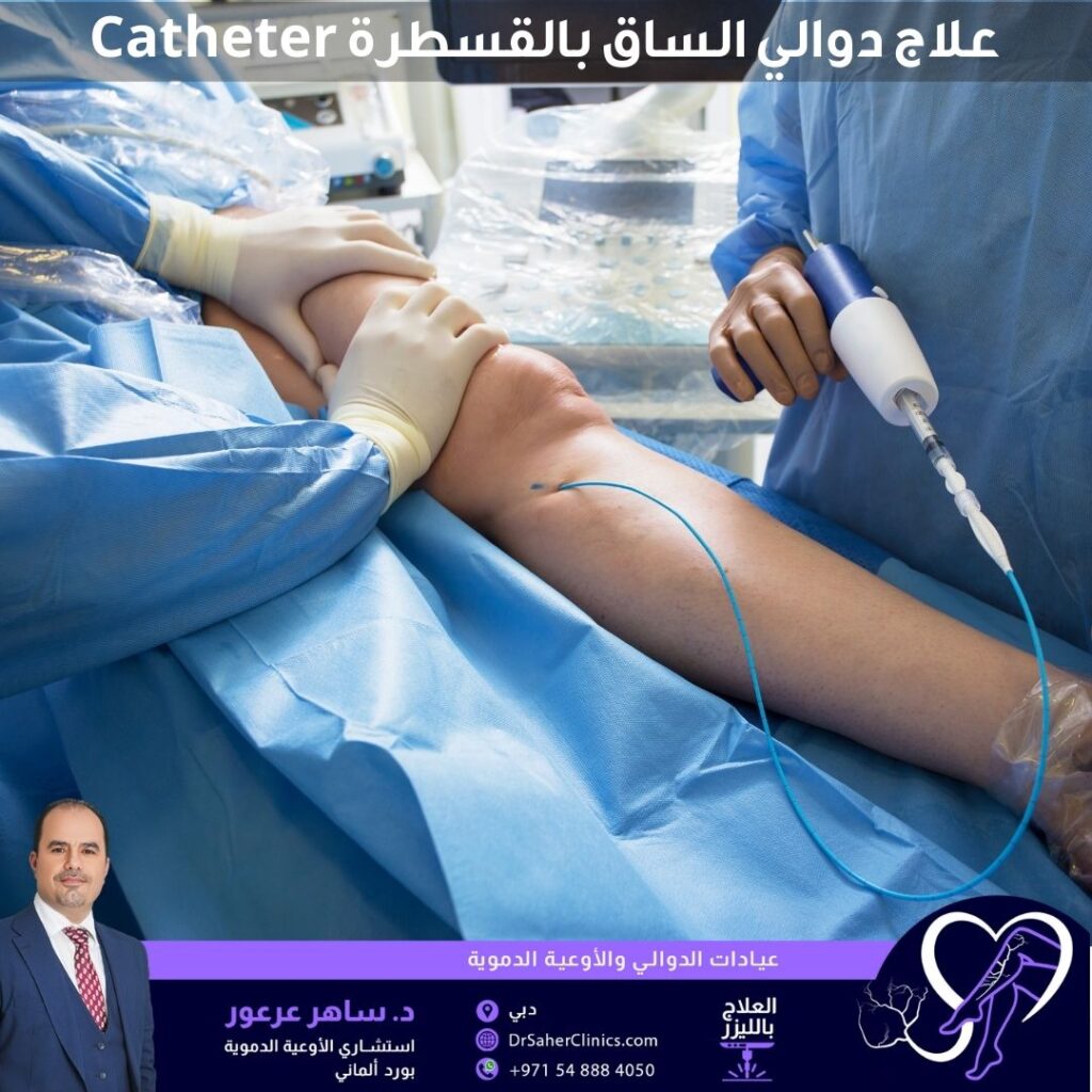 Catheter Varicose Veins Treatment