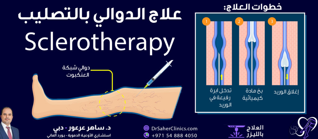 شرح علاج الدوالي بالتصليب Sclerotherapy