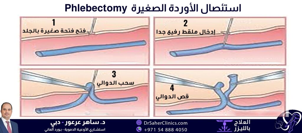 علاج الدوالي بالجراحة، تطبيق علاج دوالي الساق بالجراحة