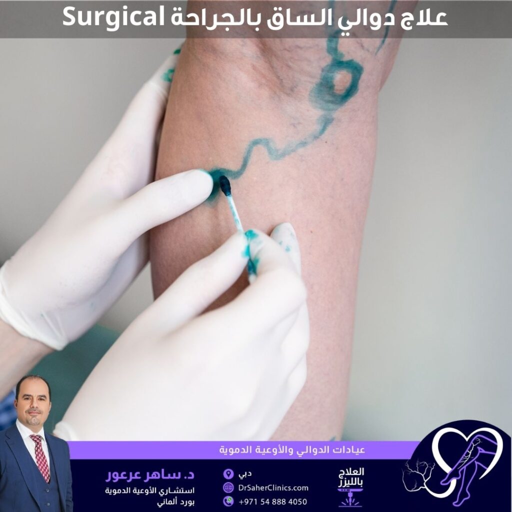 علاج الدوالي بالجراحة