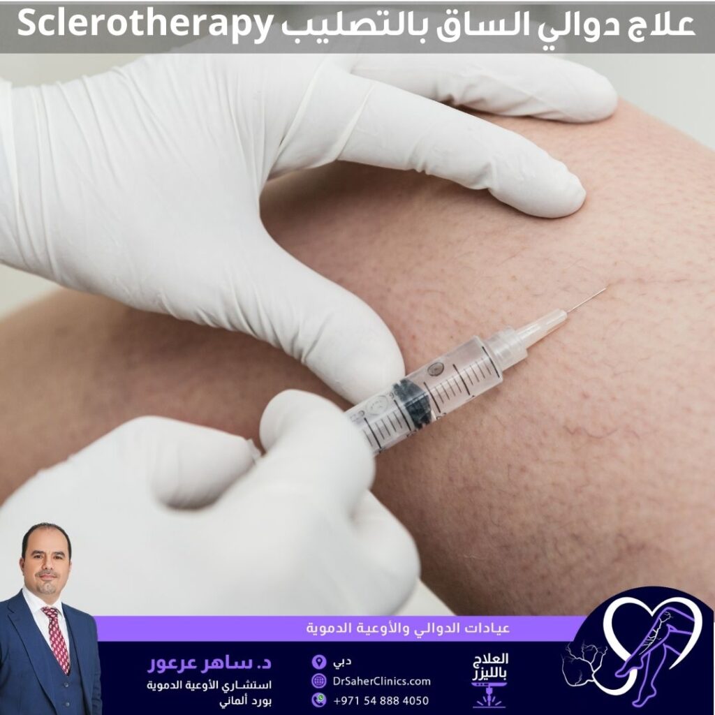 علاج دوالي الساق بالتصليب Sclerotherapy
