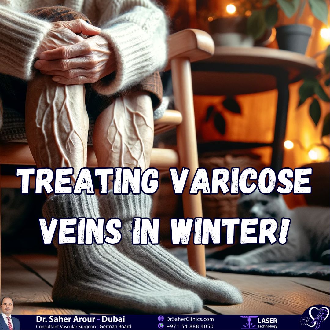 Treating Varicose Veins in Winter. 7 Benefits