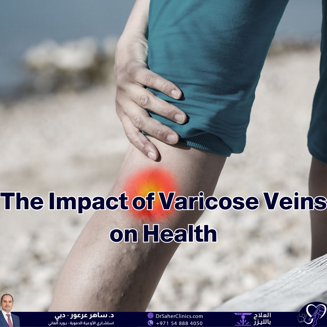 What is the impact of varicose veins on health, and daily life? What are the best clinic for treating varicose veins ?