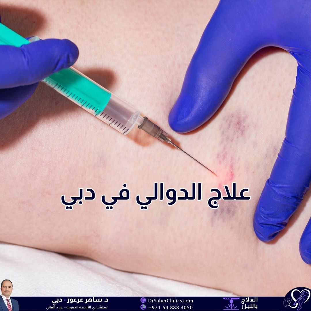 ما هي الدوالي وما أسبابها وما هي أعراضها؟ وما هي طرق علاج الدوالي في دبي ومن هو أفضل طبيب مختص في علاج الدوالي في دبي؟