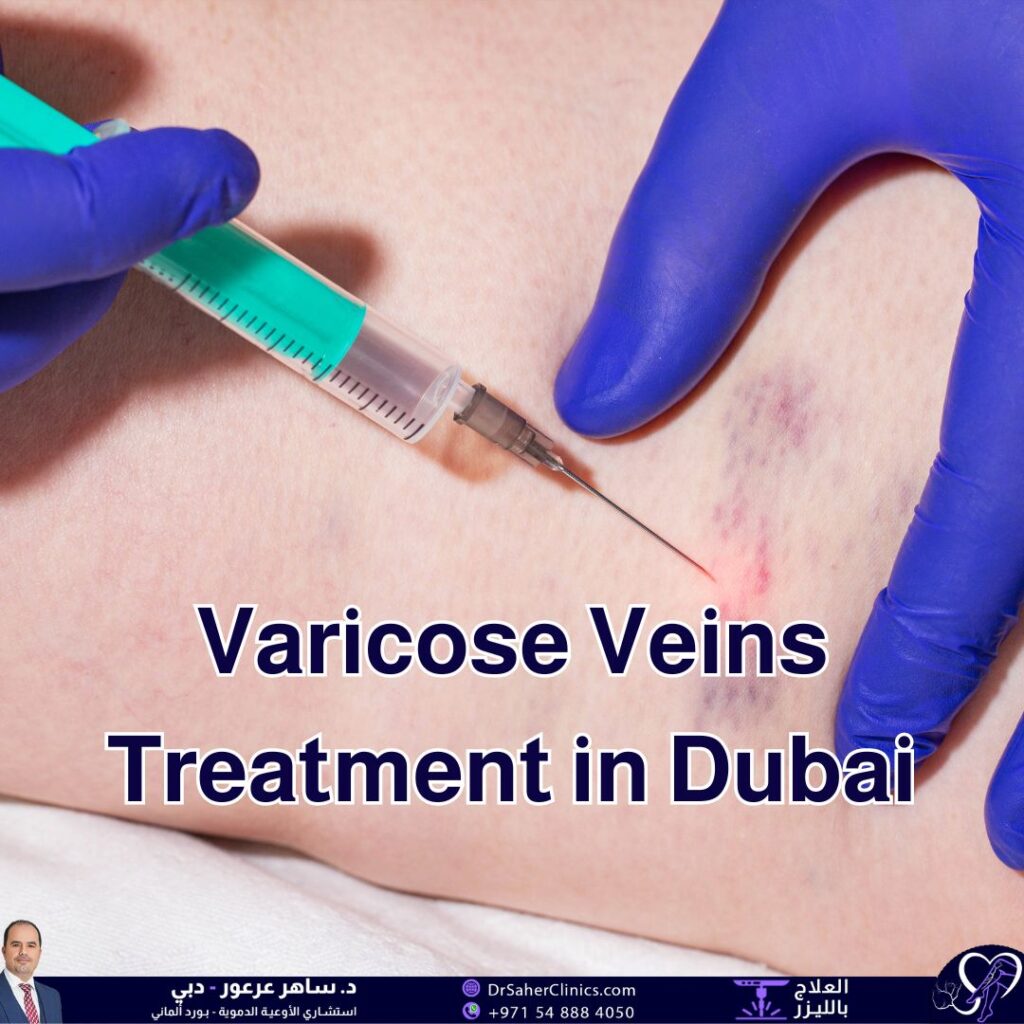 What are Varicose Veins, and what are Varicose Veins Treatment in Dubai? Who is the Best Specialist for Treating Varicose Veins in Dubai?