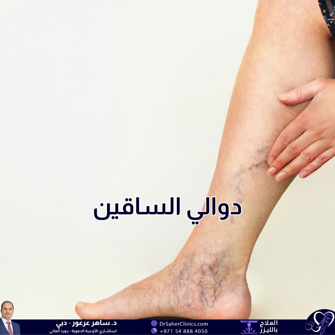 ما هي دوالي الساقين؟ ما أسبابها وما أعراضها وكيف يتم الوقاية منها؟ كيف يتم علاجها وما هي أفضل العيادات المختصة في علاج دوالي الساقين؟
