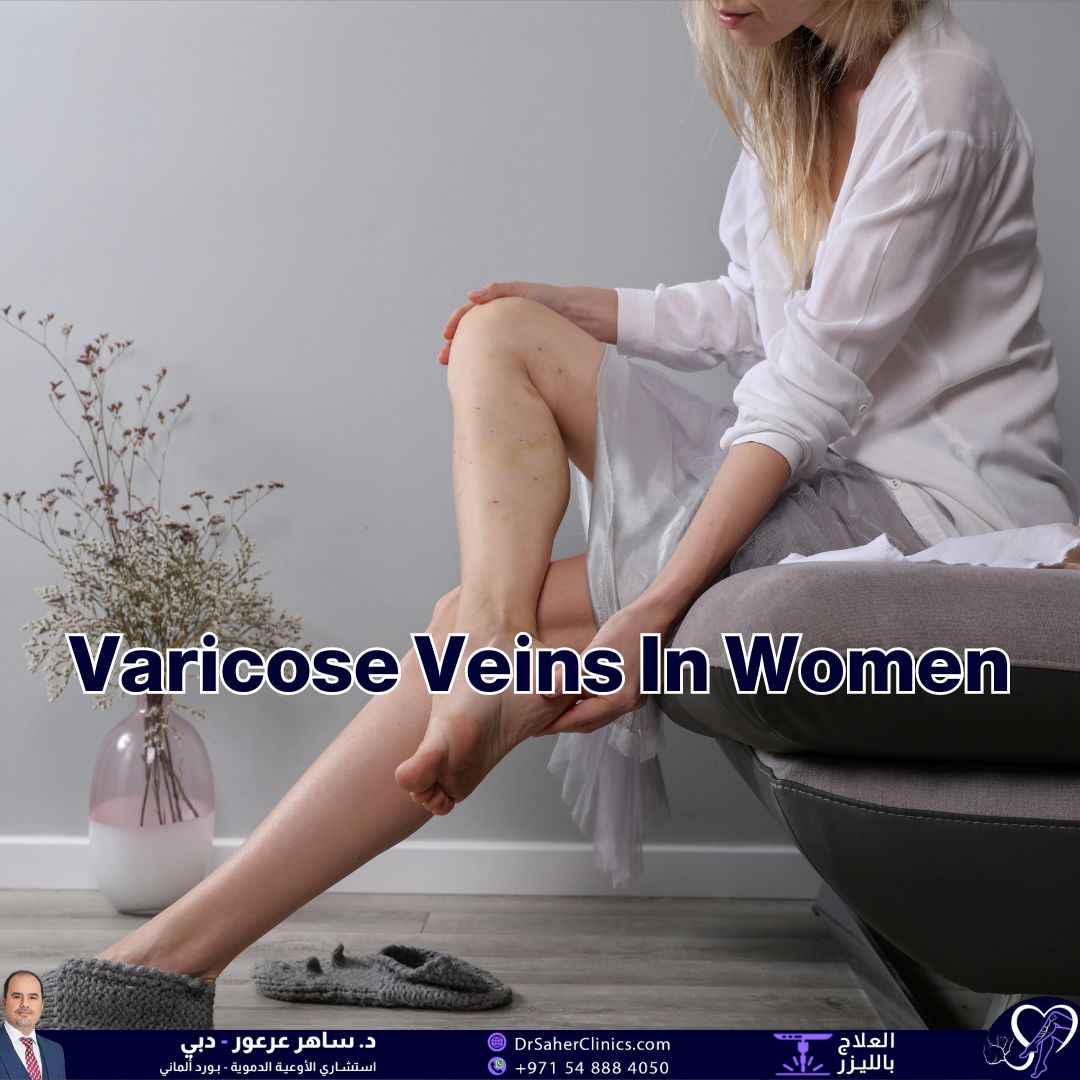 What are the causes of varicose veins in women, what are the treatment options, and what are the best clinics specialized in treating them