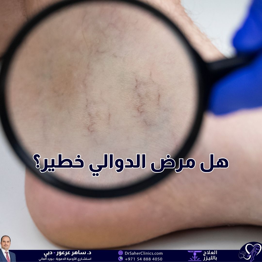 هل مرض الدوالي خطير وما هي أسبابه وأعراضه؟ متى يجب القلق من مرض الدوالي وما هي الخيارات العلاجية؟ وما هي أفضل العيادات لعلاج مرض الدوالي؟