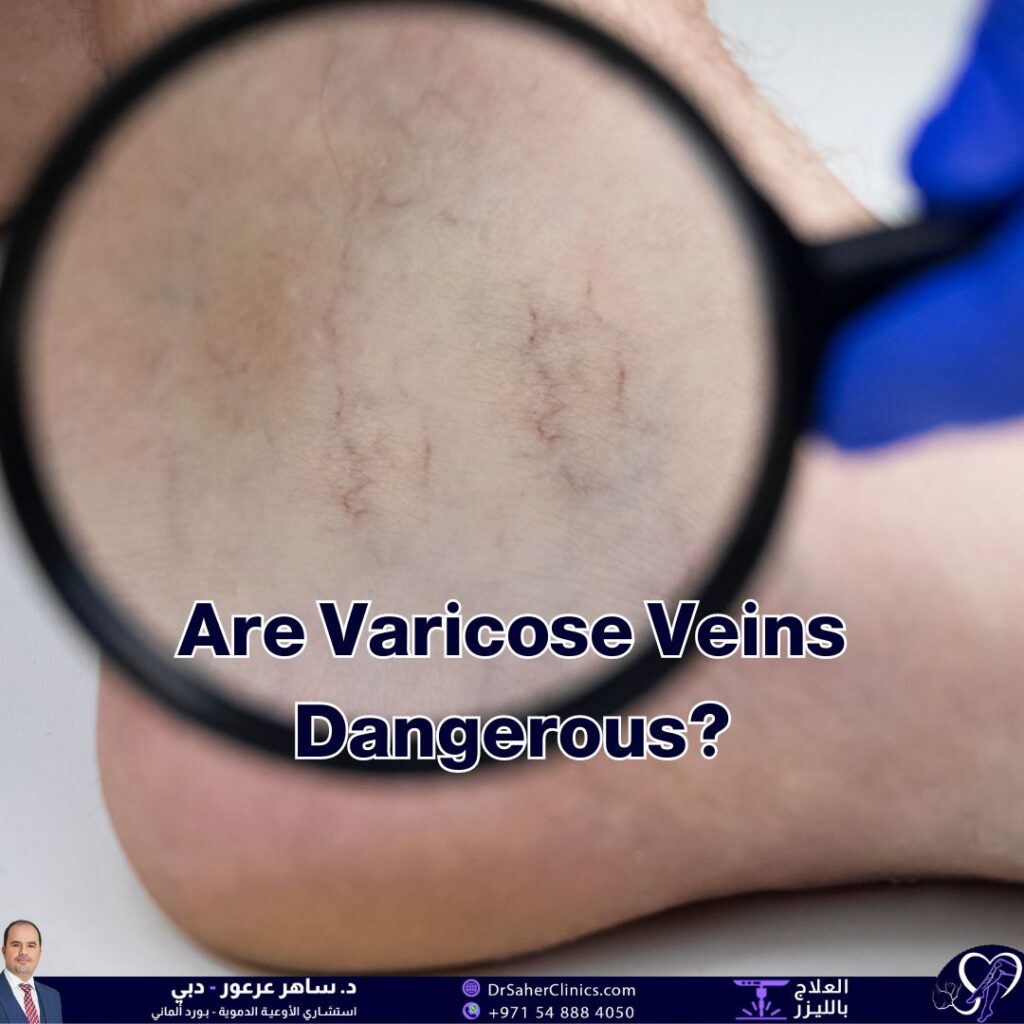 Are varicose veins dangerous, and when should you be concerned about them What are the best clinics for treating varicose vein