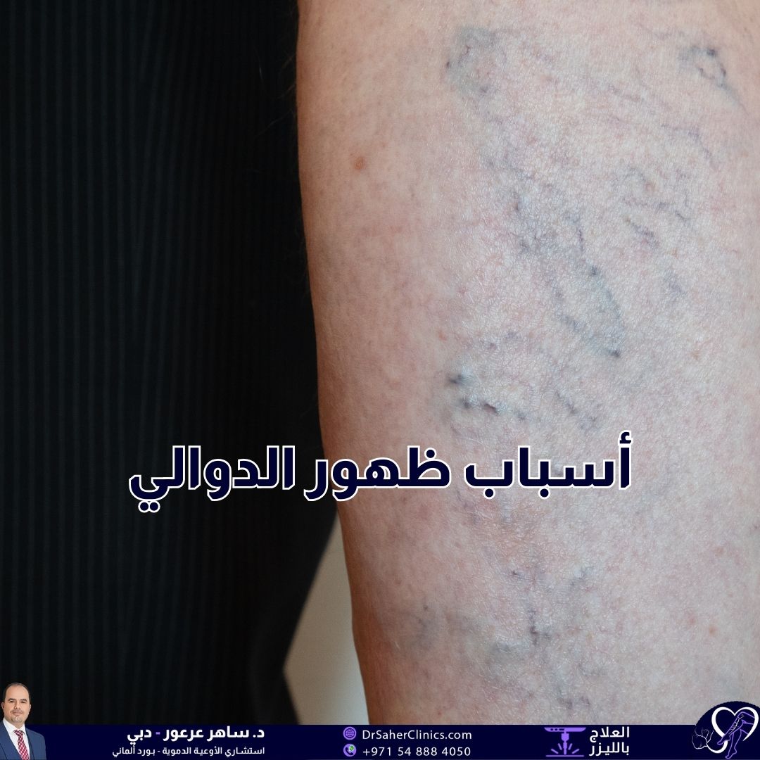 ما هي أسباب ظهور الدوالي وكيف يمكن الوقاية منها وما هي أفضل العيادات لعلاج الدوالي والأوعية الدموية بشكل عام؟