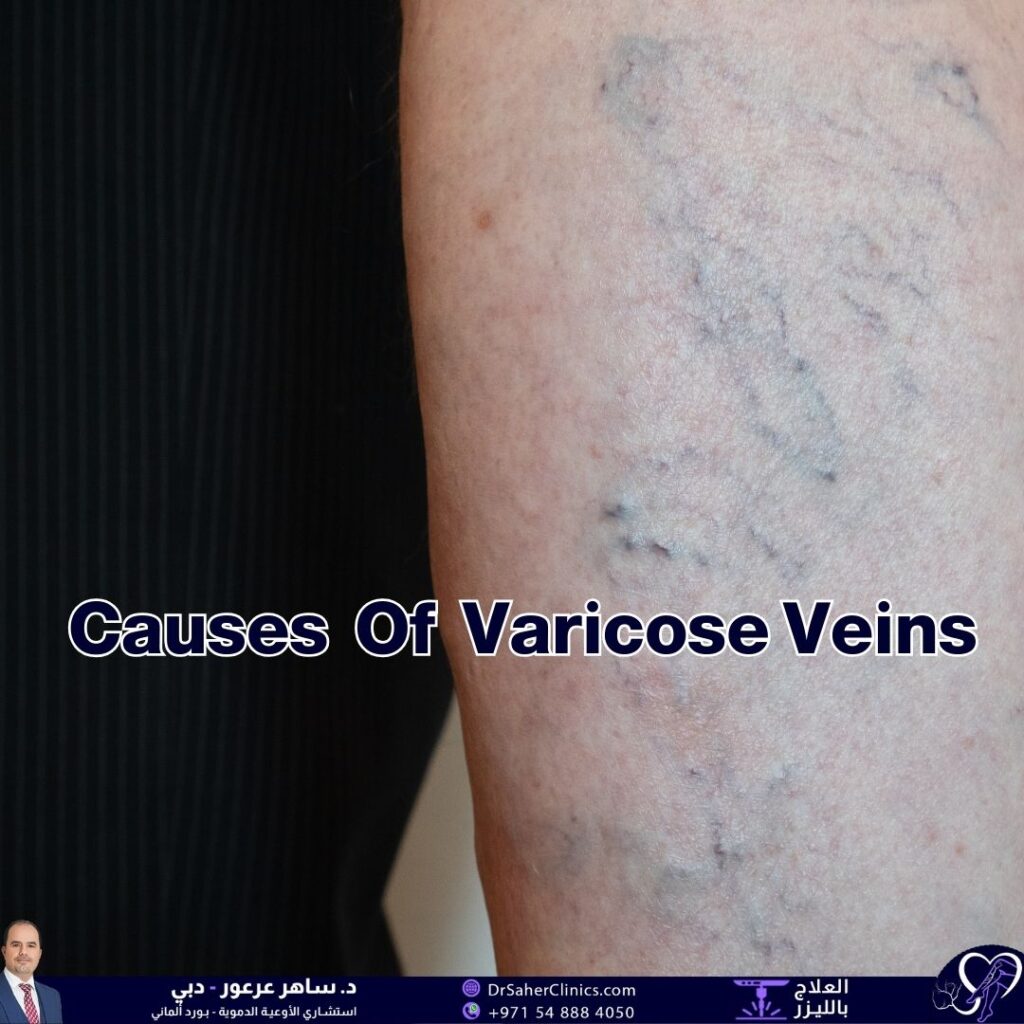 What Causes Varicose Veins and How Can They Be Prevented? What Are the Best Clinics for Treating Varicose Veins and Vascular Conditions?