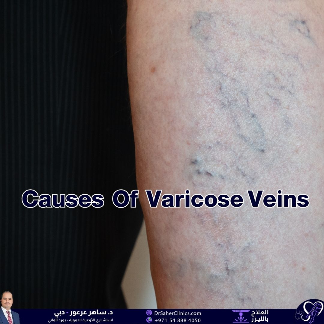 What Causes Varicose Veins and How Can They Be Prevented? What Are the Best Clinics for Treating Varicose Veins and Vascular Conditions?