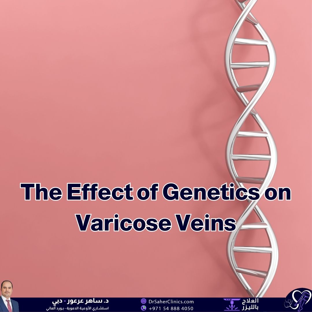 What is the effect of genetics on varicose veins? And what are the best clinics specializing in varicose vein treatment?